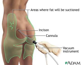 How to Maintain Liposuction Results